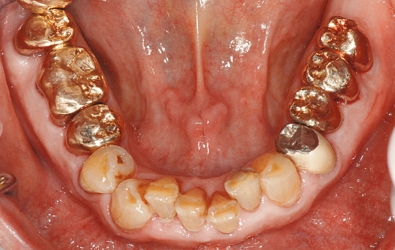 Abb. 7e Klinische Situation nach prothetischer Versorgung des prämolarisierten Zahnes 36 und des Zahnes 35 mit verblockten Goldkronen sowie Verblockung des hemisezierten Zahnes 47 mit dem Zahn 46.