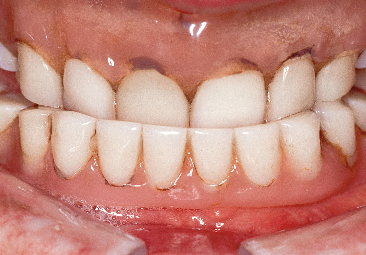 Abb. 12 Ausgangssituation: Basis inkongruent mit dem Tegument, künstliche Zähne stark abradiert, erheblicher Verlust an Vertikaldimension mit Altersprogenie, Funktionsrand defekt.
