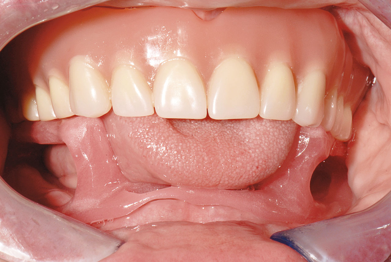 Abb. 16 Abformmassenträger im Mund des Patienten.