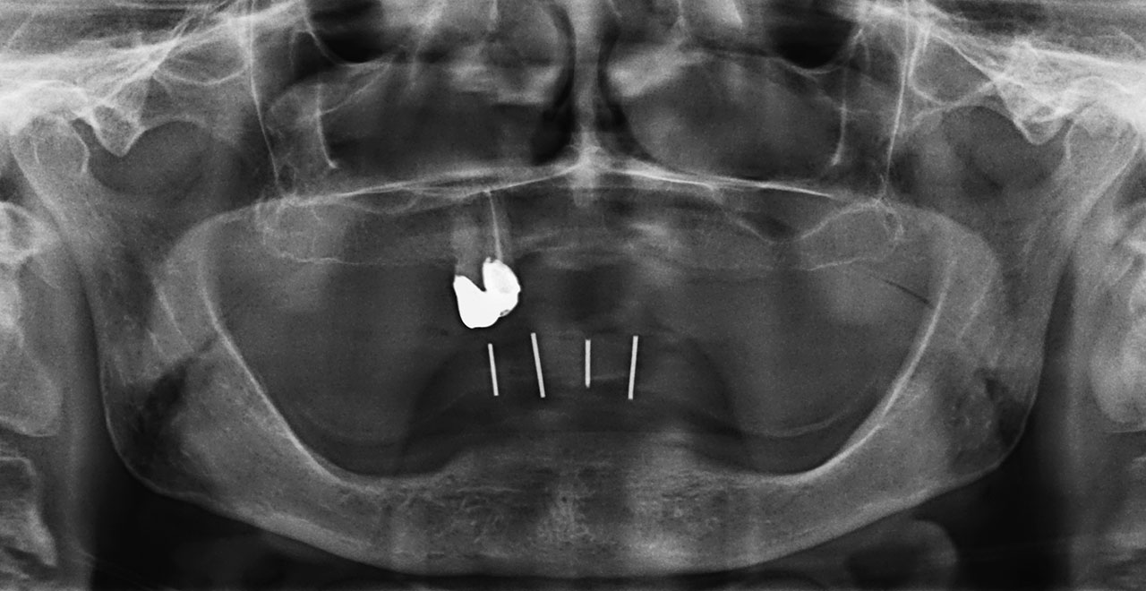 Abb. 2 Panoramaschichtaufnahme mit Klammerdrahtmarkierungen in der vorhandenen Prothese zur Abschätzung des Knochenangebots im zahnlosen Unterkiefer.