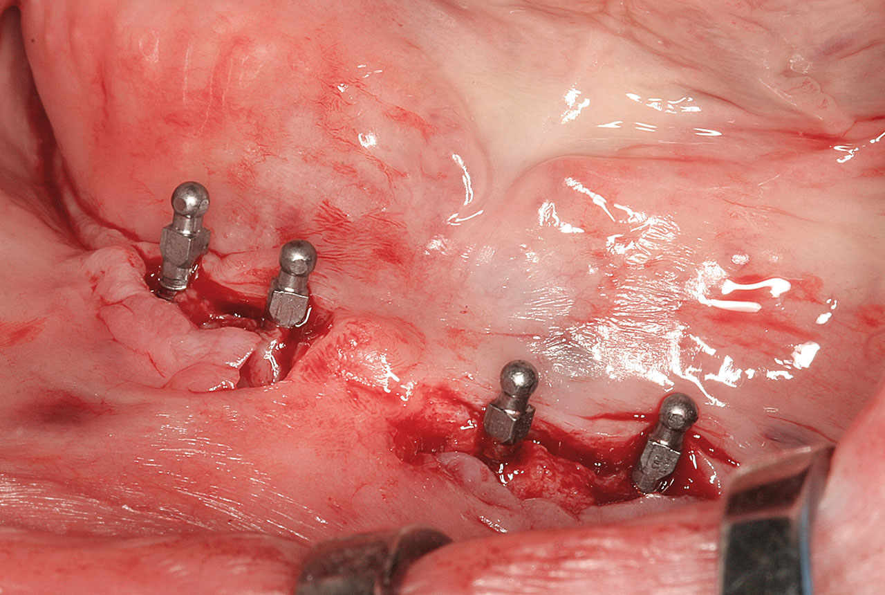 Abb. 3 Miniimplantate (2,1 × 13 mm) inseriert vor Nahtverschluss der Mukosalappen.