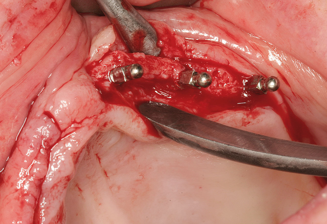 Abb. 9 Insertion der ersten drei Miniimplantate (Durch­messer 2,4 mm) bei stark reduzierter Alveolarkammbreite im Oberkiefer.