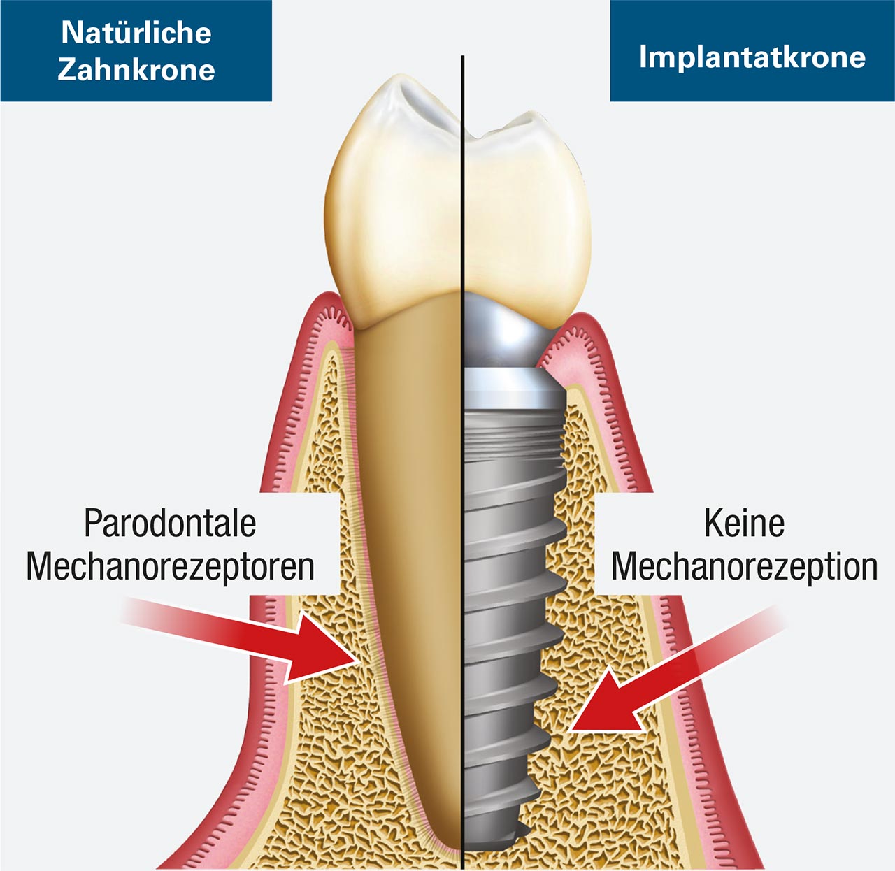 Zahnimplantat Dekomposition Modell Oral Teaching Modell 4x Implantat Interpretation Modell 