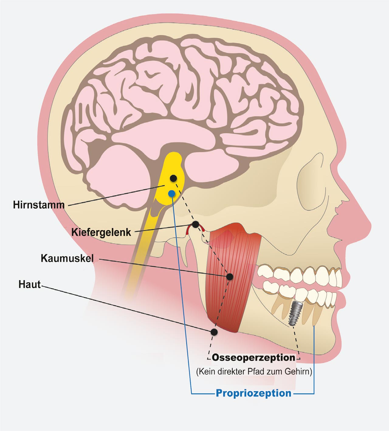 Abb. 2 Das parodontale Ligament enthält parodontale Mechanorezeptoren (PDM), die eine wichtige Quelle für taktile sensorische Inputs für das zentrale Nervensystem darstellen. Dem PDM fällt eine Schlüsselrolle bei der sensorischen Unterscheidungsfähigkeit zu. Es gibt Rückmeldung über die Größe, die Richtung und die Rate der okklusalen Last für die sensorisch e Wahrnehmung sowie die motorische Funktion des Kiefers (Propriozeption). Obwohl einem Implantat dieser Schutzmechanismus gegen die biomechanische Kraftüberlastung fehlt, erfährt es eine minimale Mechanisierung aus dem Kiefergelenk, der damit verbundenen Muskulatur und den kutanen Strukturen (Osseoperzeption). 