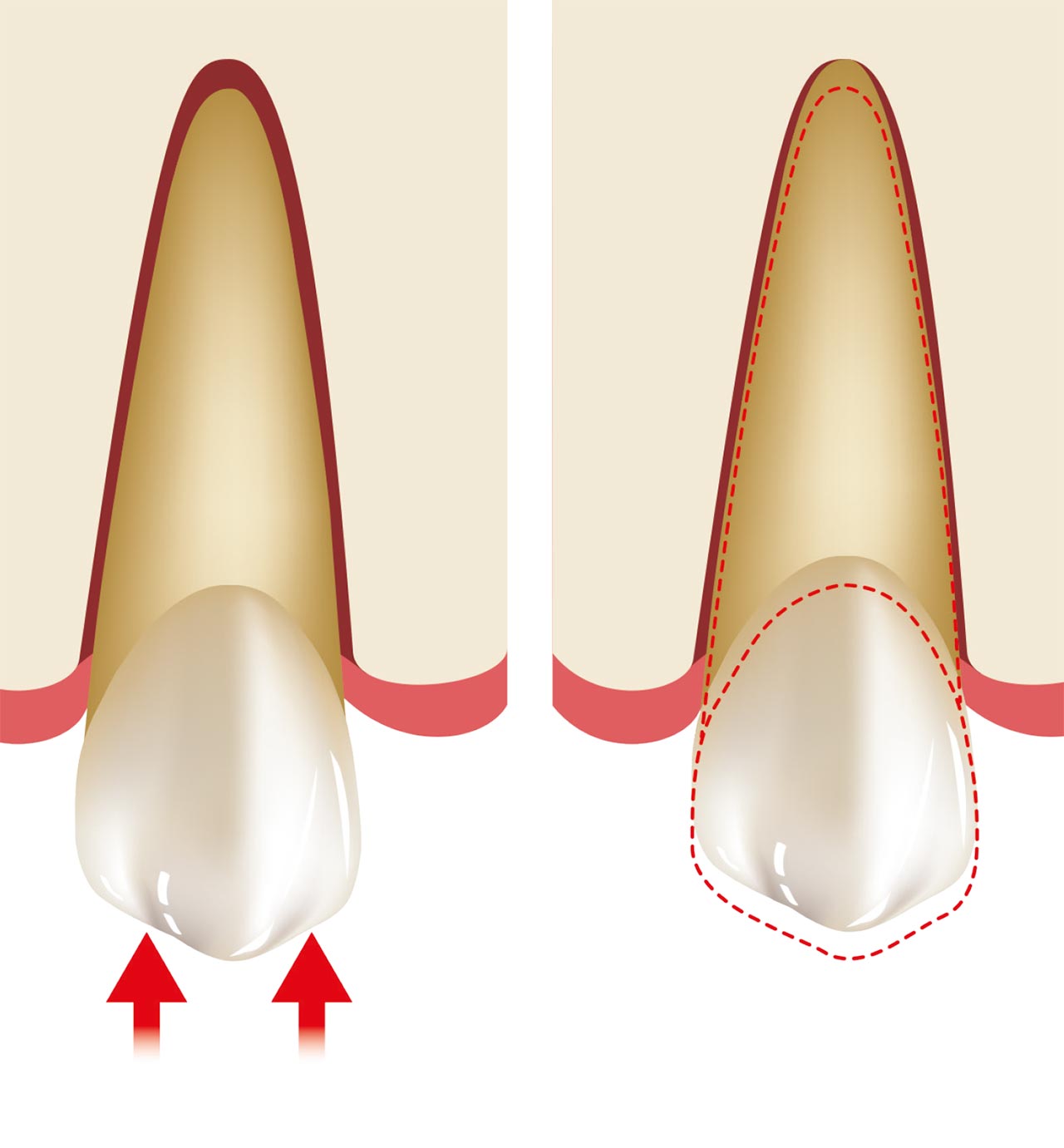 Abb. 3 Kräfte, die auf die Zähne wirken, führen zu einer Bewegung in zwei Phasen: Anfangsbewegungsphase, in der die Bewegung innerhalb der Grenzen des PDL liegt; ...