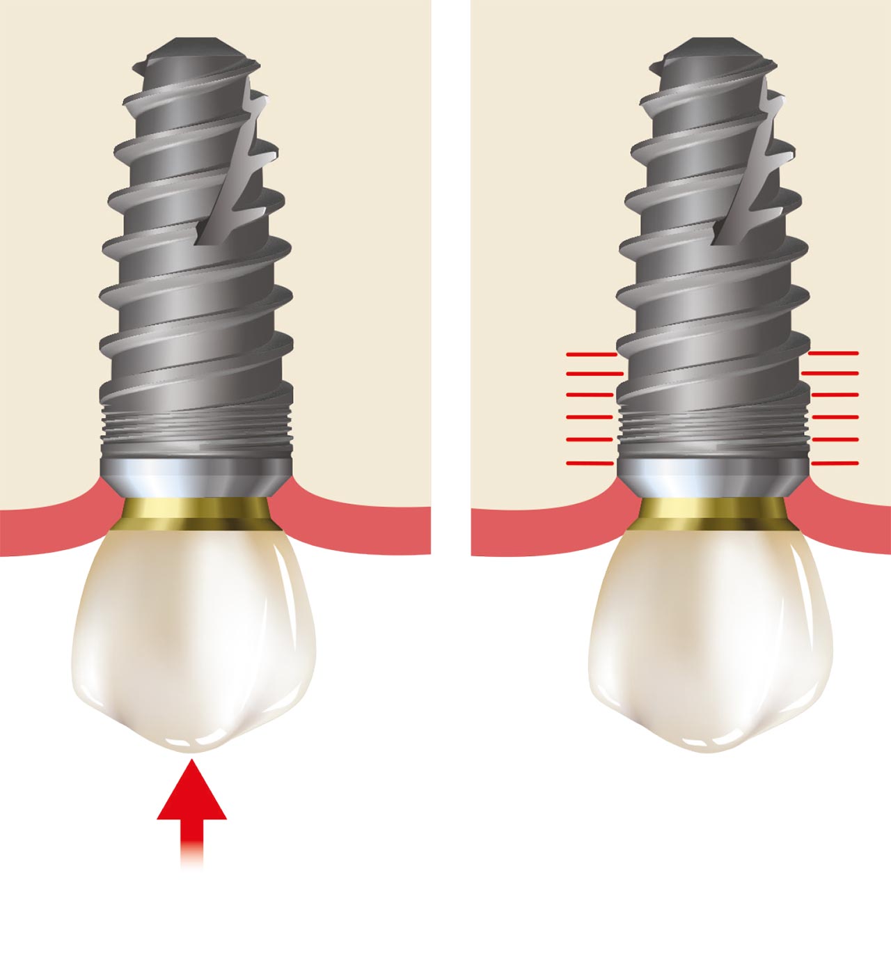 Abb. 5 Die axiale Kraft auf ein Implantat führt zu Druckkräften, die auf den Crestalknochen wirken; solange die Kraft innerhalb der physiologischen Grenzen liegt, führt diese nicht zu Knochenverlust.