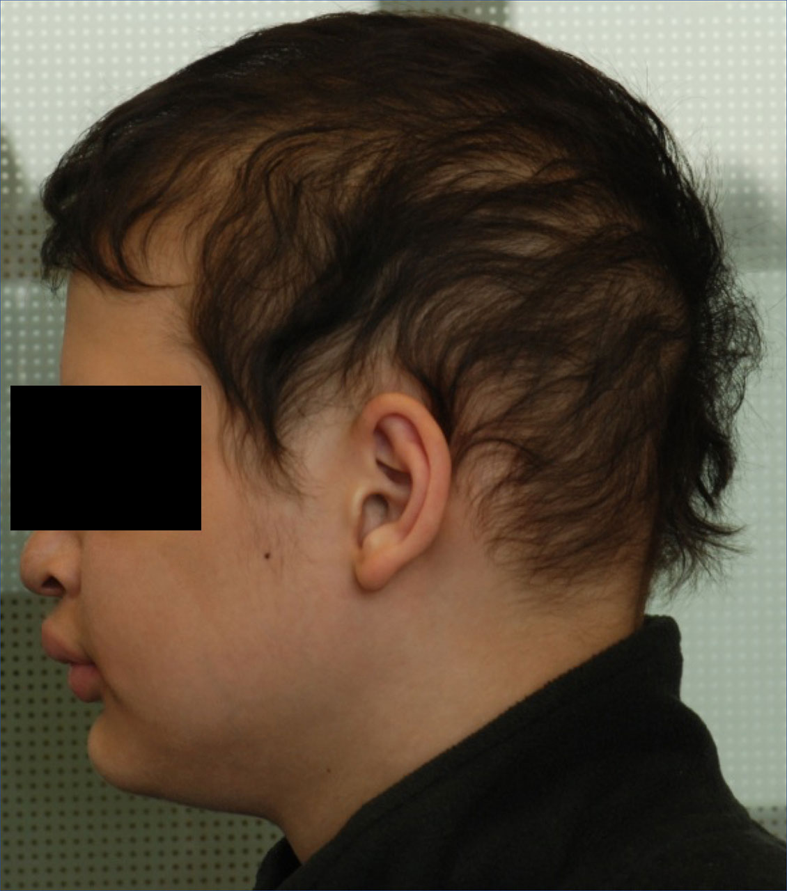 Abb. 2 Seitenprofil des jüngeren  Bruders mit Hypotrichose und reduzierter vertikaler unterer Gesichtshälfte