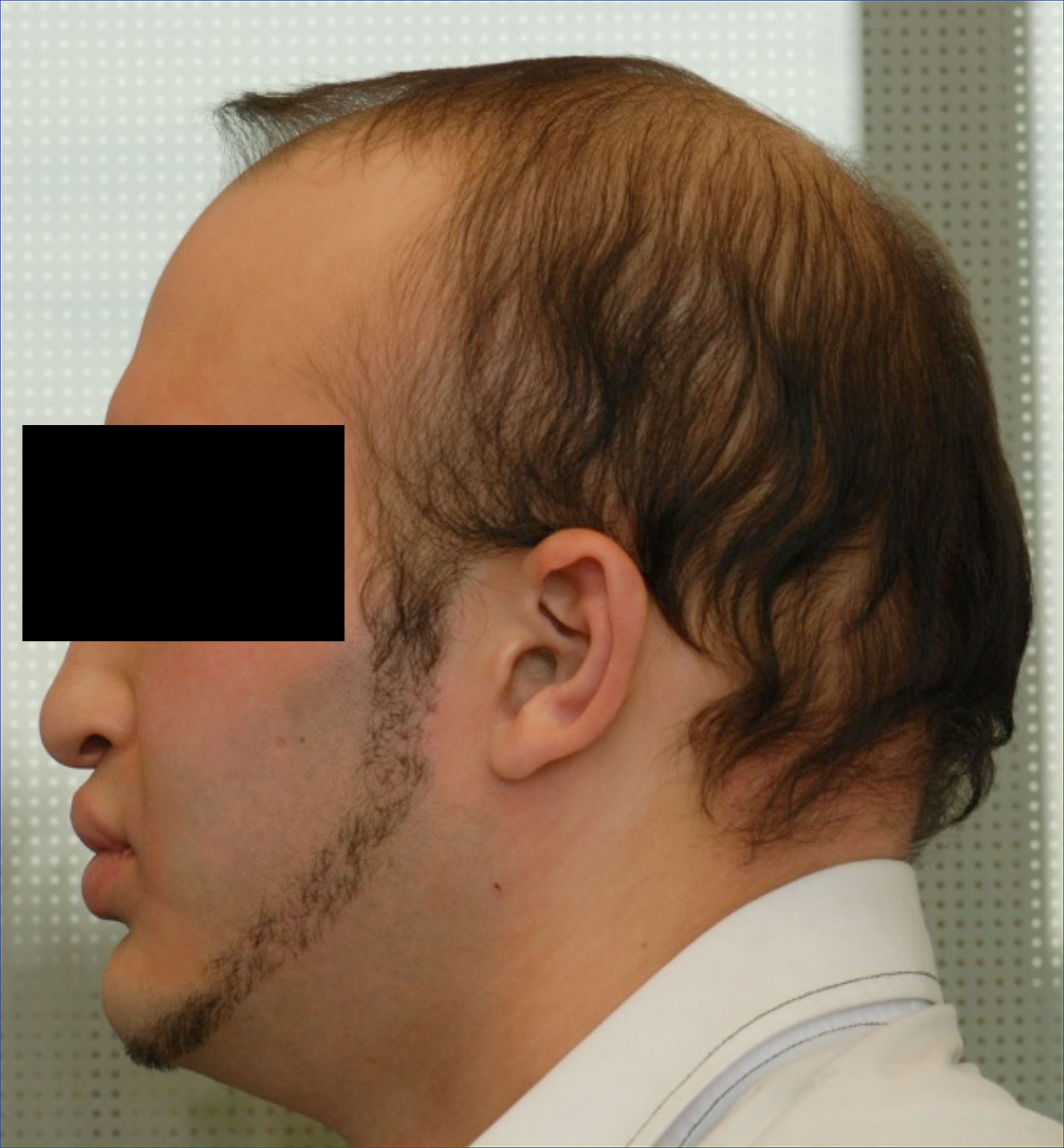 Abb. 3 Seitenprofil des älteren Bruders  mit Hypotrichose und reduzierter vertikaler  unterer Gesichtshälfte