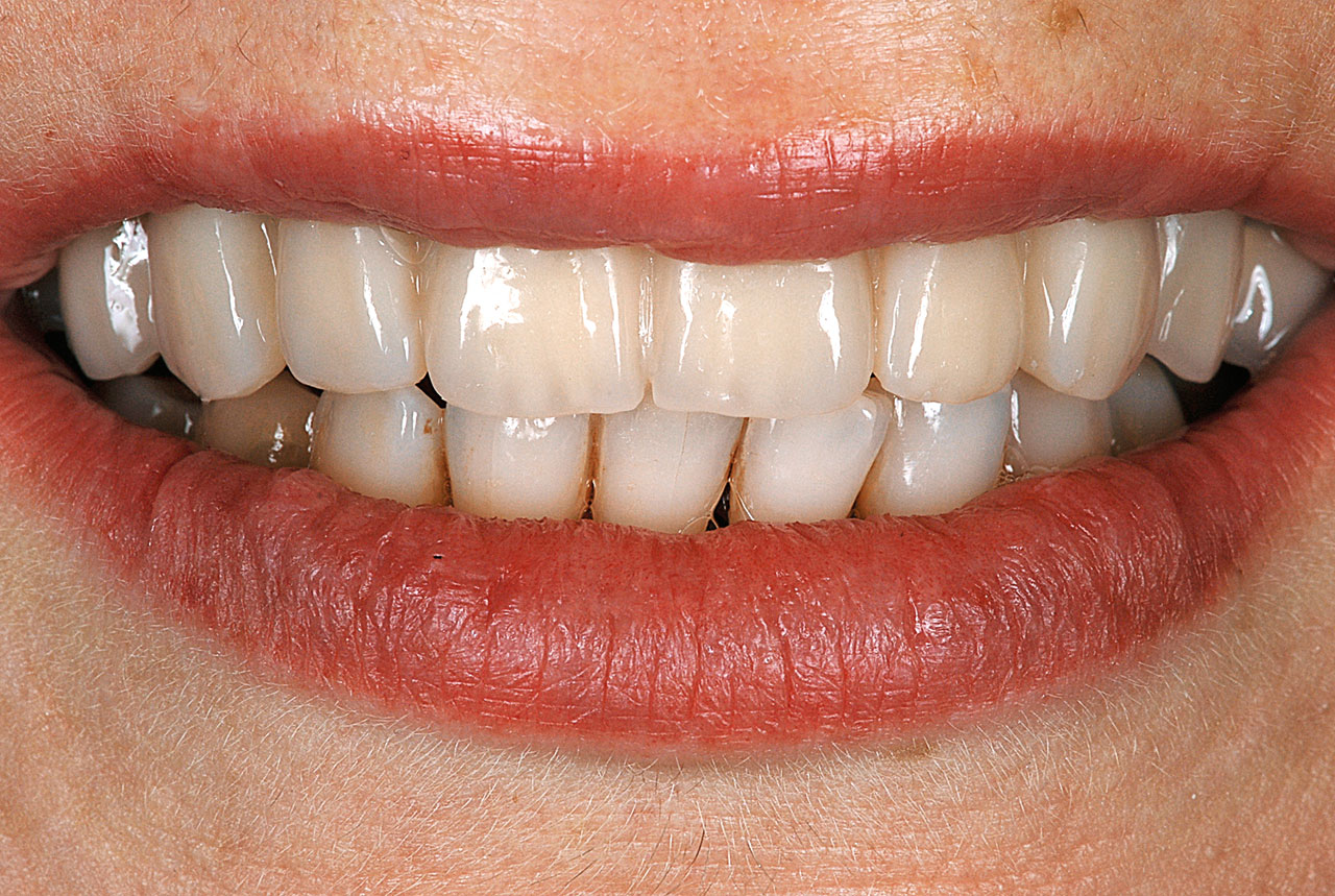 Abb. 2c Eingegliedert im Mund des Patienten (Fotos: Philipp von der Osten).