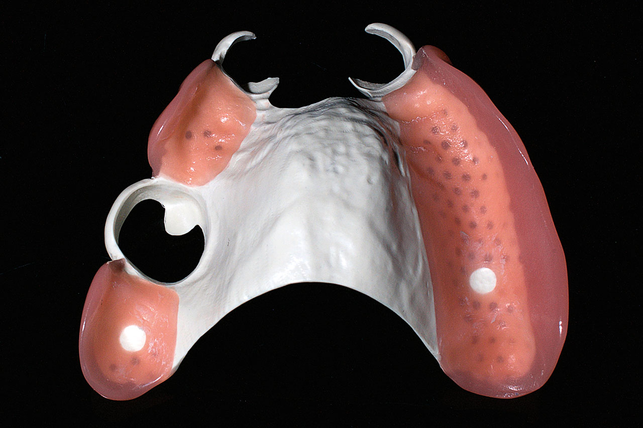 Abb. 11a Herausnehmbare Oberkieferteilprothese aus PAEK-Werkstoff (Ultaire AKP, Solvay Dental 360) mit Übergang zum Prothesenkunststoff, basal, ...