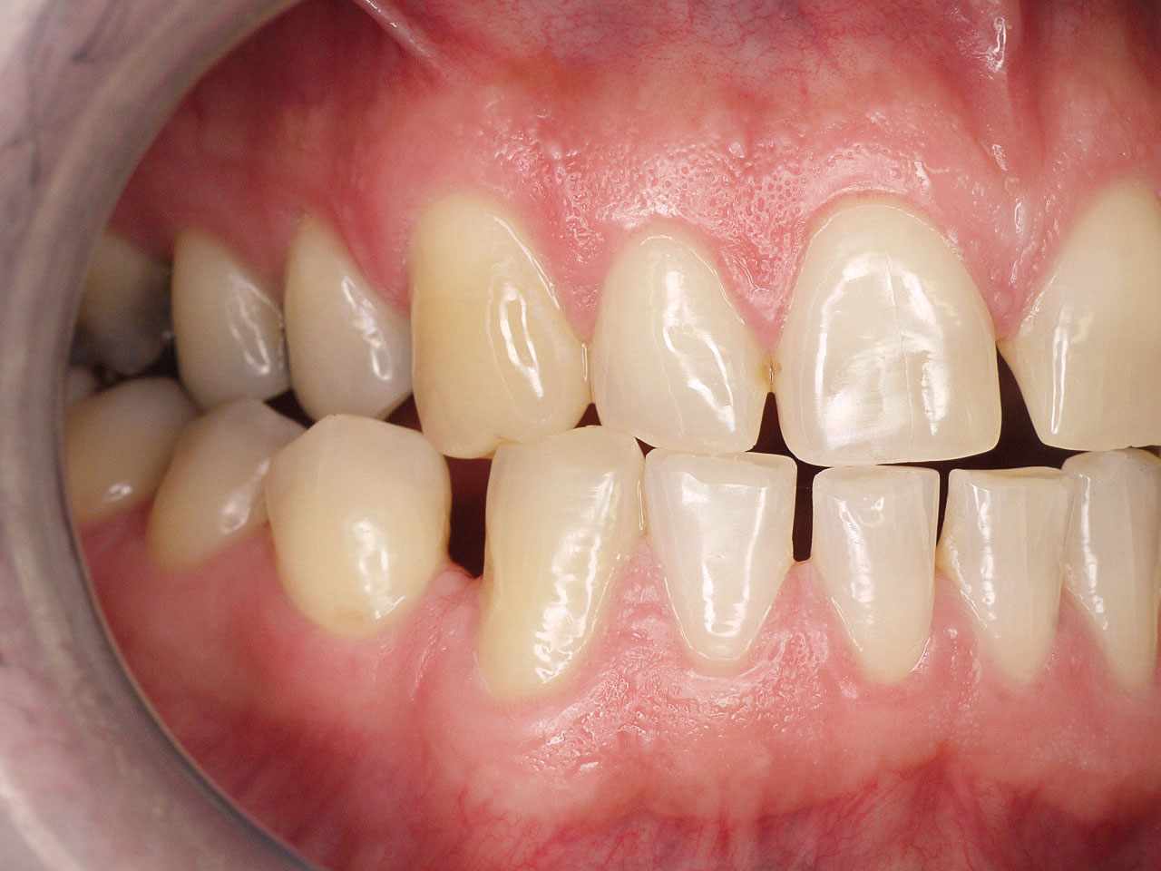 Abb. 2 Verlust der Eckzahnführung durch Bruxismus und dadurch Gruppenführung mit beginnenden Zahnhalsdefekten.