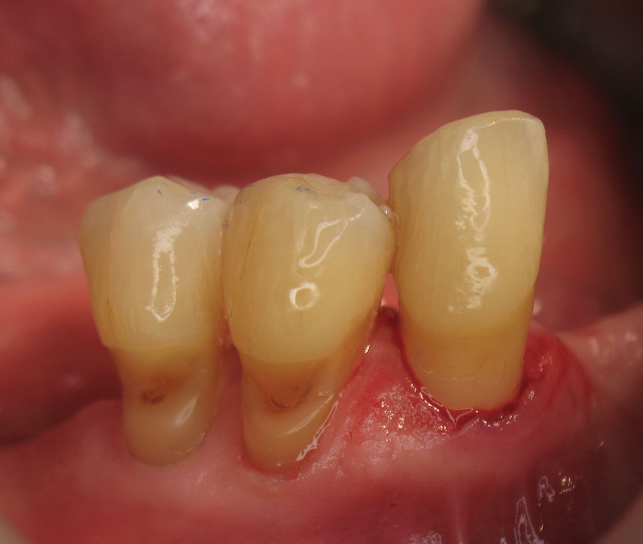 Der Patientenfall: Parodontale Erkrankung mit ausgeprägten Zahnhalsdefekten