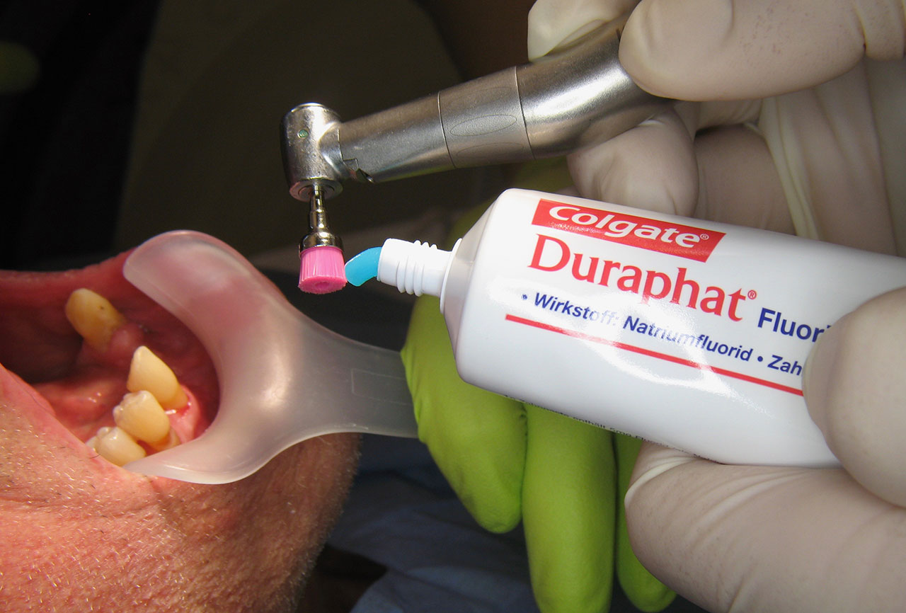 Einsatz der Duraphat Zahnpasta im Rahmen der UPT