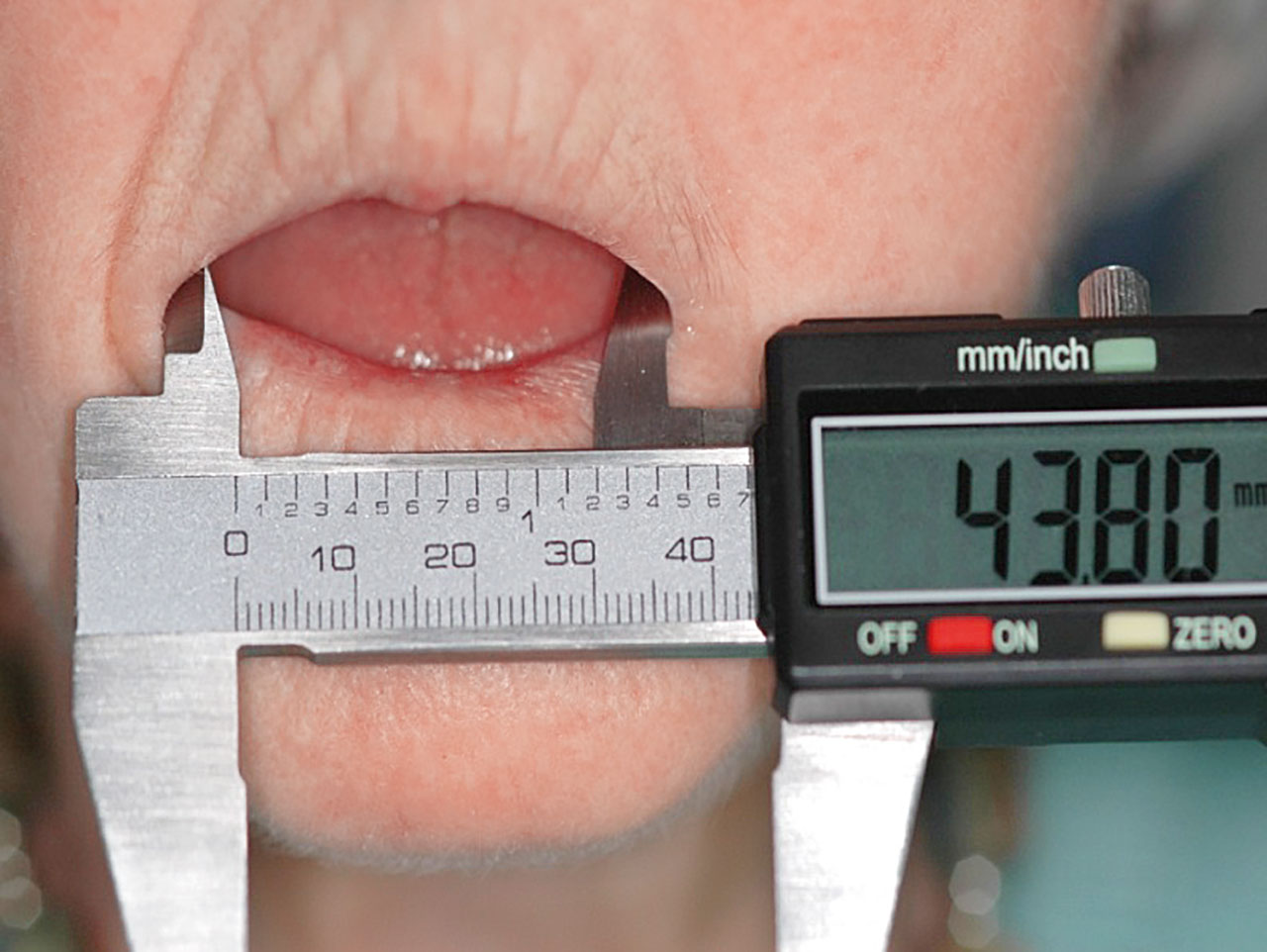 Abb. 2 Durch Mikrostomie eingeschränkte horizontale Mundöffnung (gleiche Patientin wie in Abb. 1).