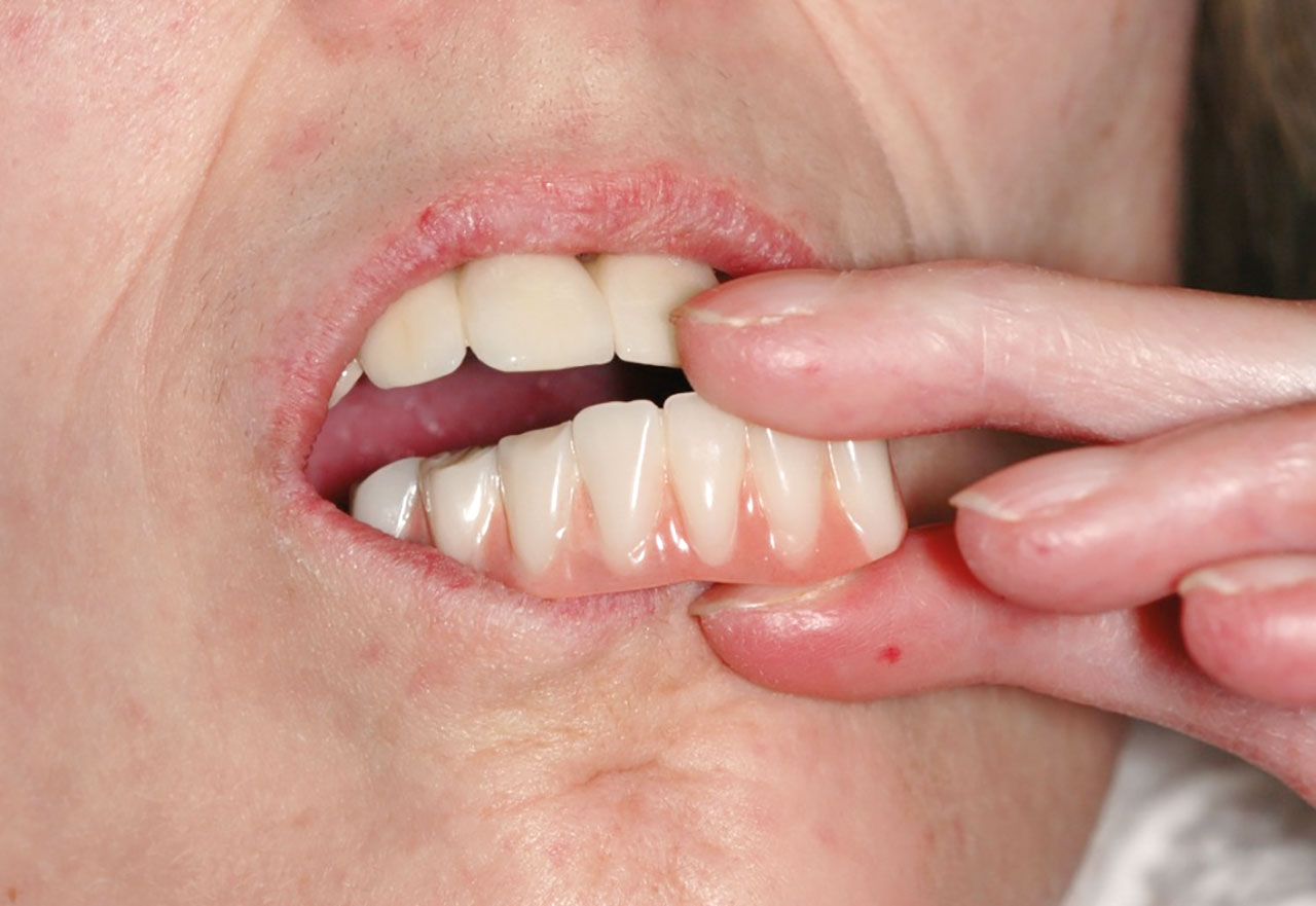 Abb. 8 Manuelle Limitation bei Eingliederung und Herausnahme von Zahnersatz. Durch die Systemsklerose ist eine Beugung der Finger nicht möglich.