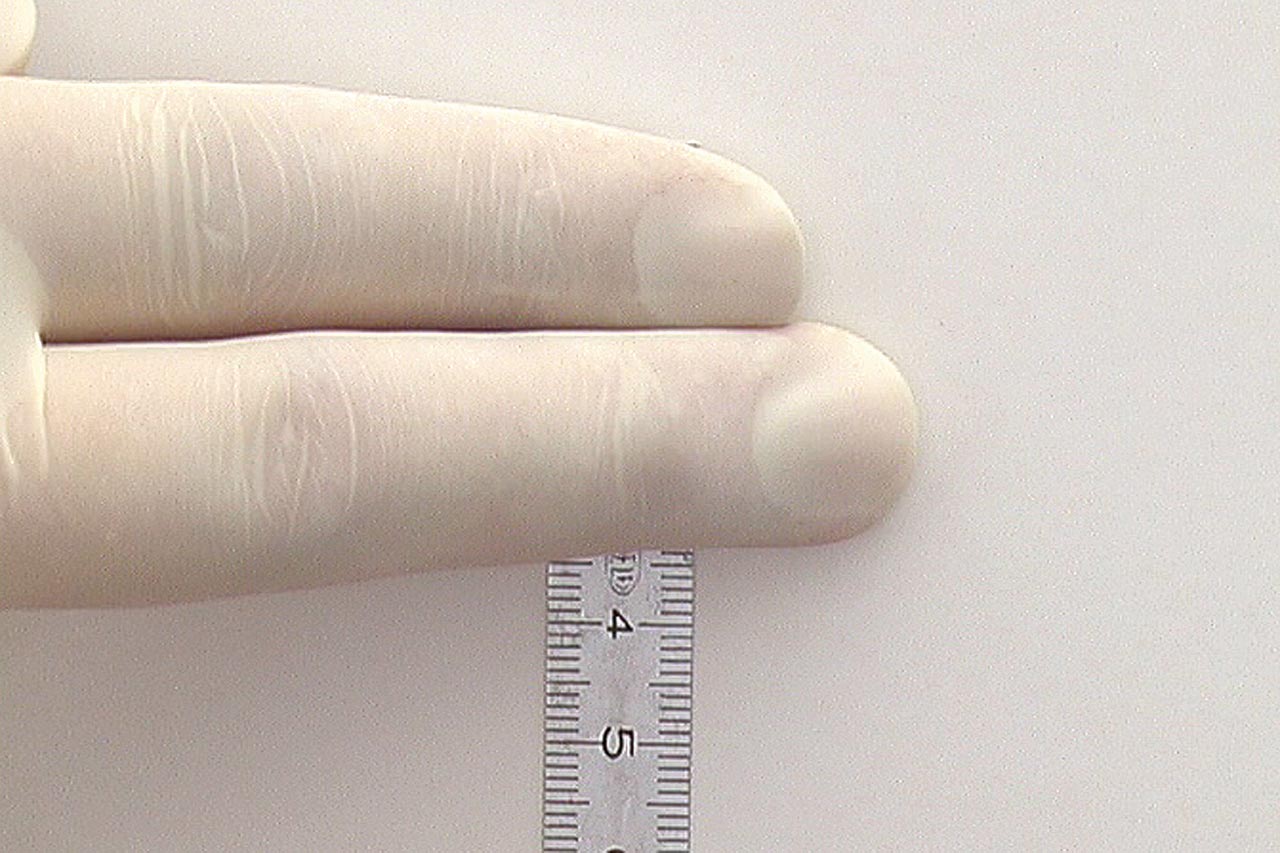 Abb. 4 Vorbereitung der Bestimmung der „Schneidekantendistanz“ mittels Messung der Breite zweier Finger  (dentaConcept)