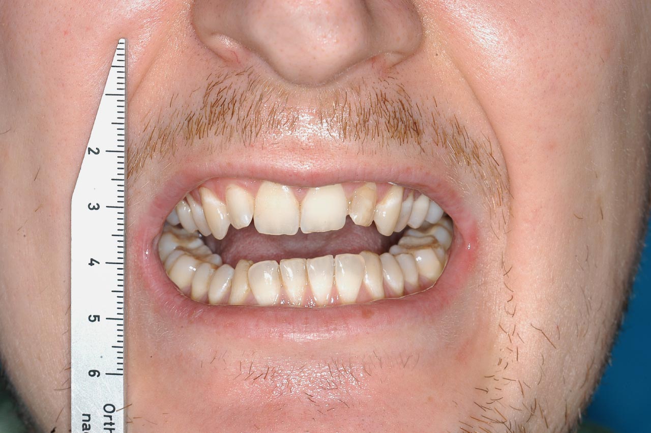 Abb. 1 Klinische Situation bei Erstvorstellung mit deutlich eingeschränkter Mundöffnung (ca. 5 mm)