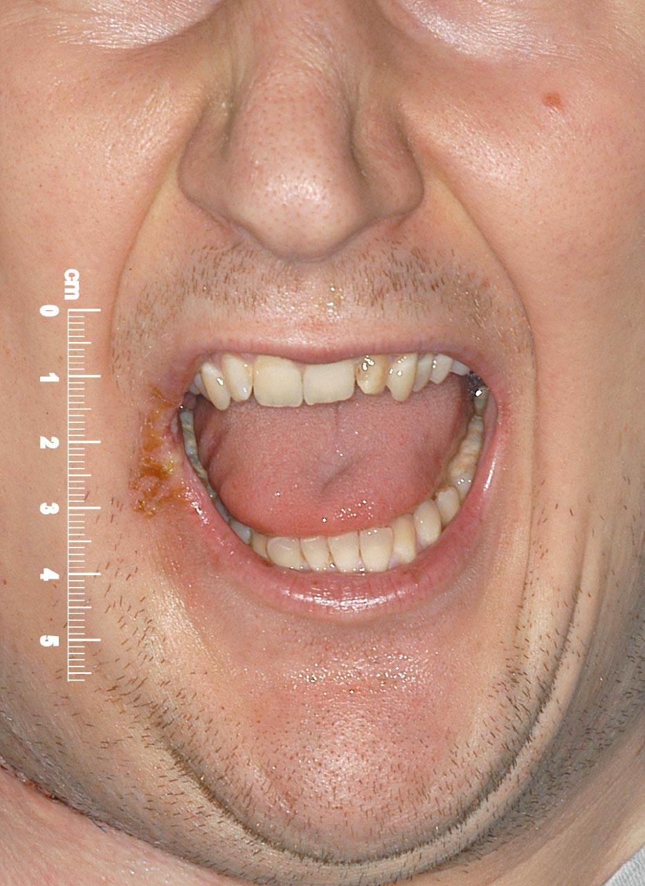  Abb. 3 Mundöffnung 3 Tage nach Resektion (ca. 25 mm)