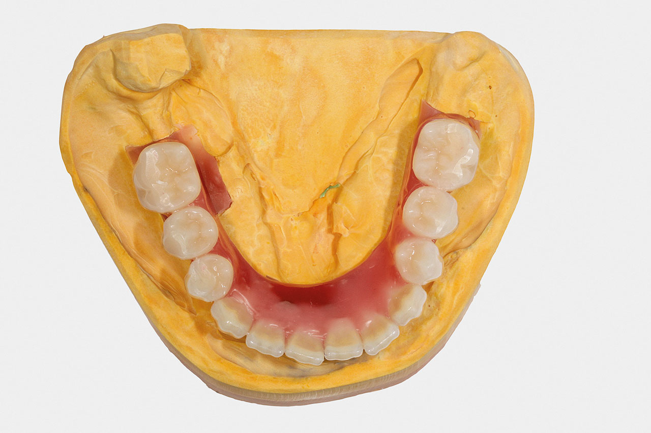 Abb. 3: Nach der Wachseinprobe wurde die Aufstellung um die zu extrahierenden Zähne vervollständigt.