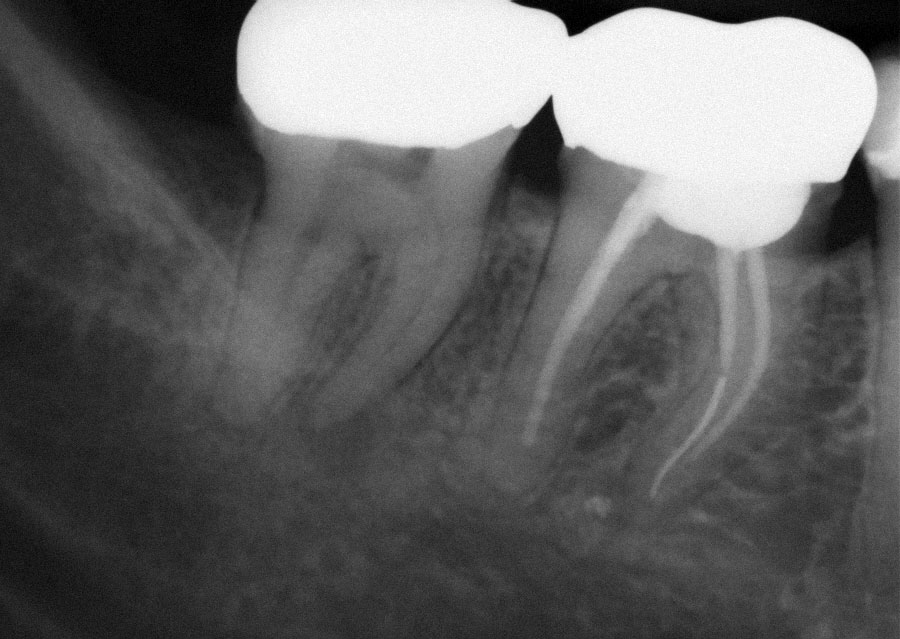 Abb. 1 Präoperative Aufnahme mit apikaler Parodontitis an Zahn 47 und abgebrochenem Instrumentenfragment in der mesialen Wurzel