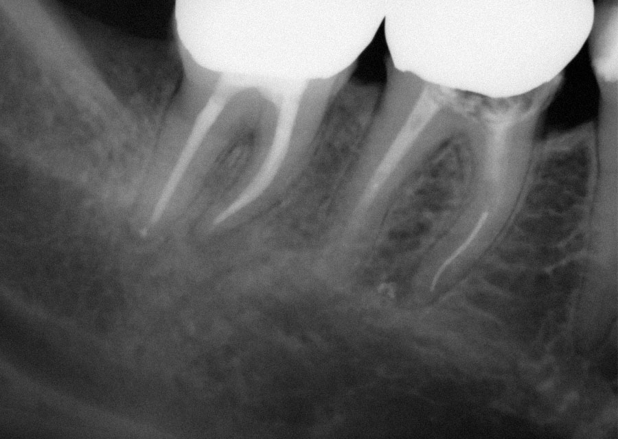 Abb. 2 Erfolgte Wurzelkanalbehandlung an Zahn 47 und entferntes Wurzelkanalfüllmaterial Zahn 46. Instrumentenfragment noch in situ