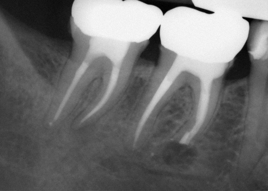Abb. 4 Mikrochirurgische Wurzelspitzenresektion der mesialen Wurzel von Zahn 46 und retrograde Wurzelkanalfüllung mit TotalFill BC Putty