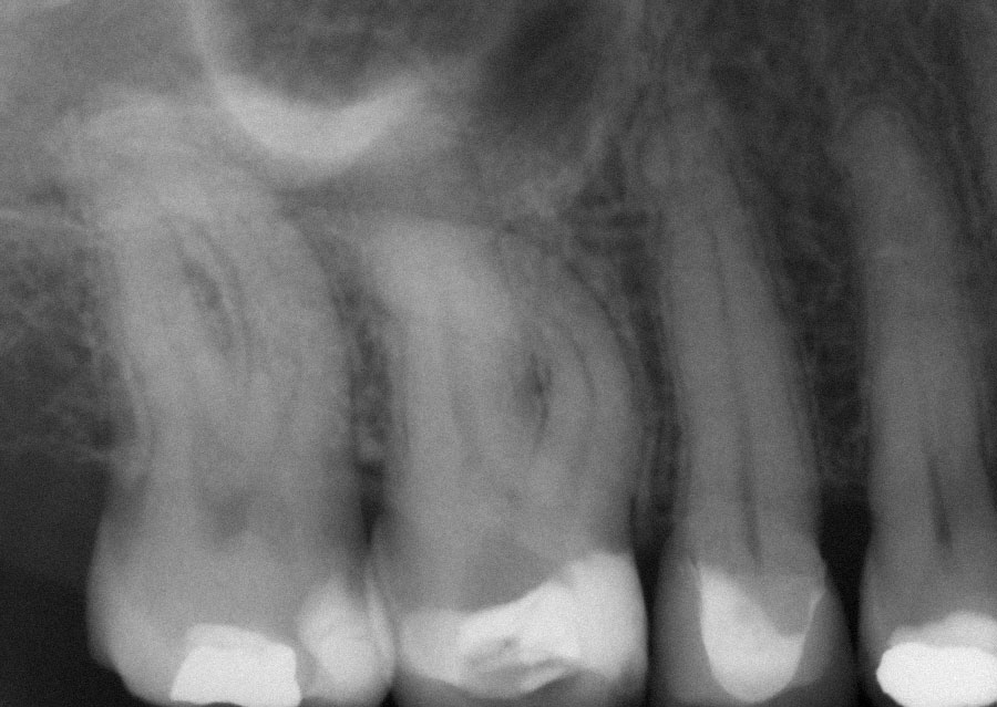 Abb. 6 Zahn 16 mit starker Krümmung der mesiobukkalen Wurzel