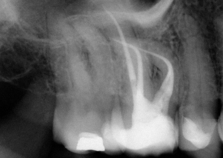 Abb. 7 Kontrollbild der Wurzelkanalfüllung Zahn 16 mit vier Kanälen