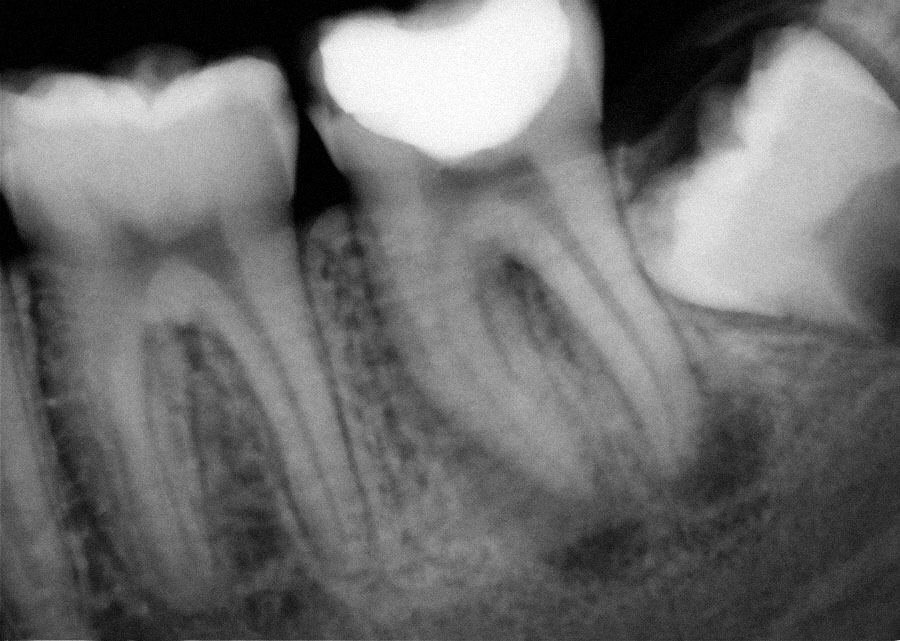 Abb. 9 Zahn 47 vor Behandlungs­beginn mit einer akuten apikalen Parodontitis