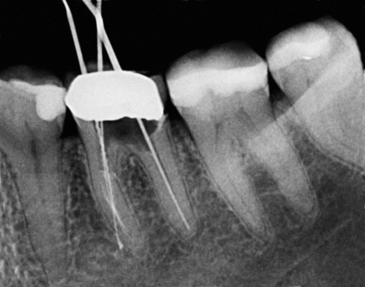 Abb. 12 Röntgenaufnahme des Überweisers mit gut erkennbarer Perforation im unteren Wurzeldrittel
