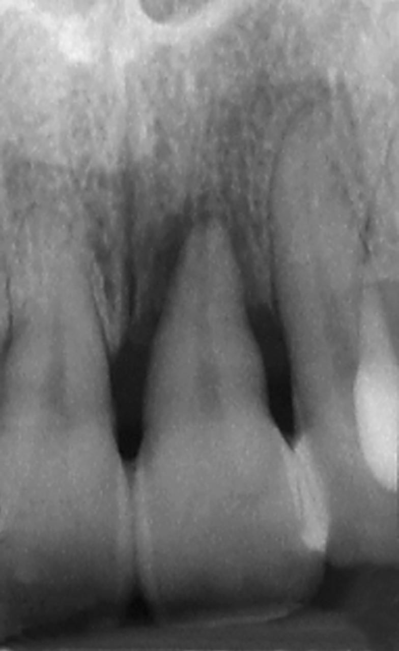 Abb. 1 und 2 38-jährige Frau mit schwerer generalisierter Parodontitis, Nichtraucherin, positive Parodontitis-Familienanamnese. Mehrere Zähne waren hypermobil (Grad 1 bis 3) und wiesen tiefe Taschen auf. Die Patientin wünschte den Erhalt ihrer Zähne und eine Verbesserung der durch Hypermobilität beeinträchtigten Funktion. Zahn 21 war vital, wies eine Mobilitätsgrad von 3 auf und wurde in der ersten Behandlungssitzung verblockt. Die parodontale Untersuchung ergab einen FMPS (Full Mouth Plaque Score) von 41 %, einen FMBS (Full Mouth Bleeding Score) von 66 % und 58 Taschen
