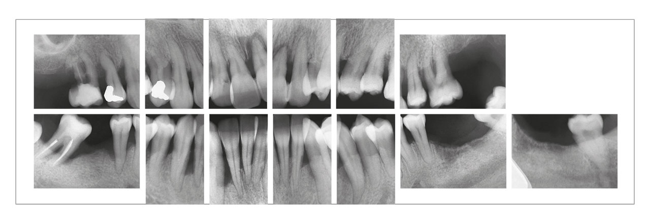 Abb. 3 Im Röntgenbild zeigte sich eine massive Zerstörung des Parodonts