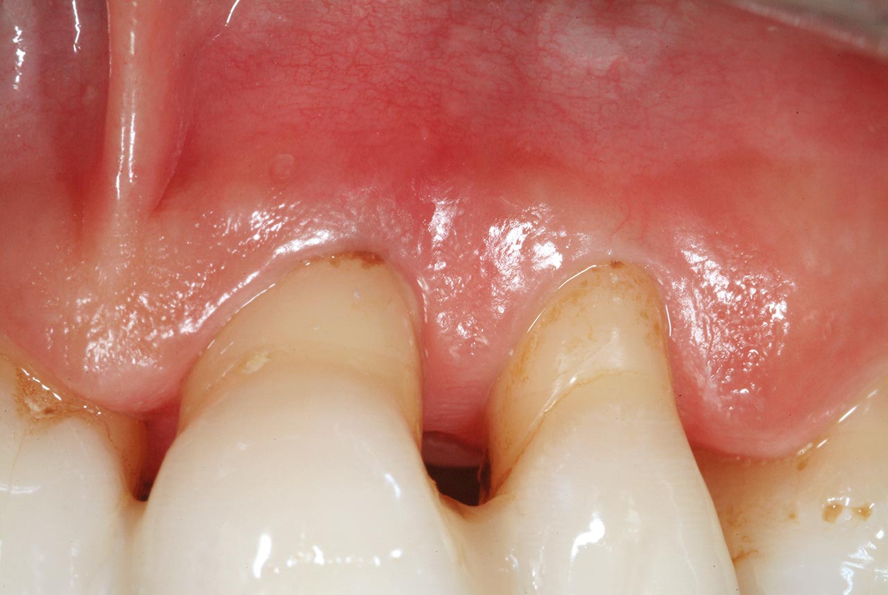 Abb. 5 Regenerativer Eingriff an Zahn 21. Parodontale Zerstörung zirkumferenziell um die Wurzel und jenseits des Apex. 