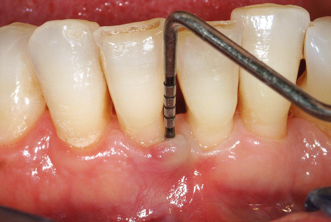 Abb. 19 und 20 Die prä- und intraoperativen Aufnahmen zeigen einen Defekt, der fast ganz um die Wurzel von Zahn 41 herumreicht und dem Apex sehr nahe kommt. Der Zahn ist vital und trotz der sehr schweren Zerstörung kaum mobil, so dass keine Verblockung erforderlich ist