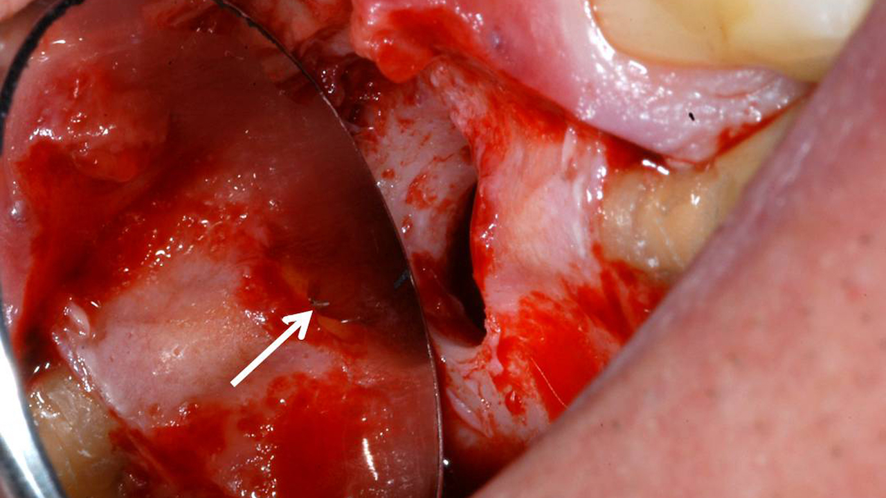 Abb. 4: Der Pfeil deutet auf das freigelegte frakturierte Wurzelkanalinstrument an der mesiobukkalen Wurzel (Foto: Dammaschke)