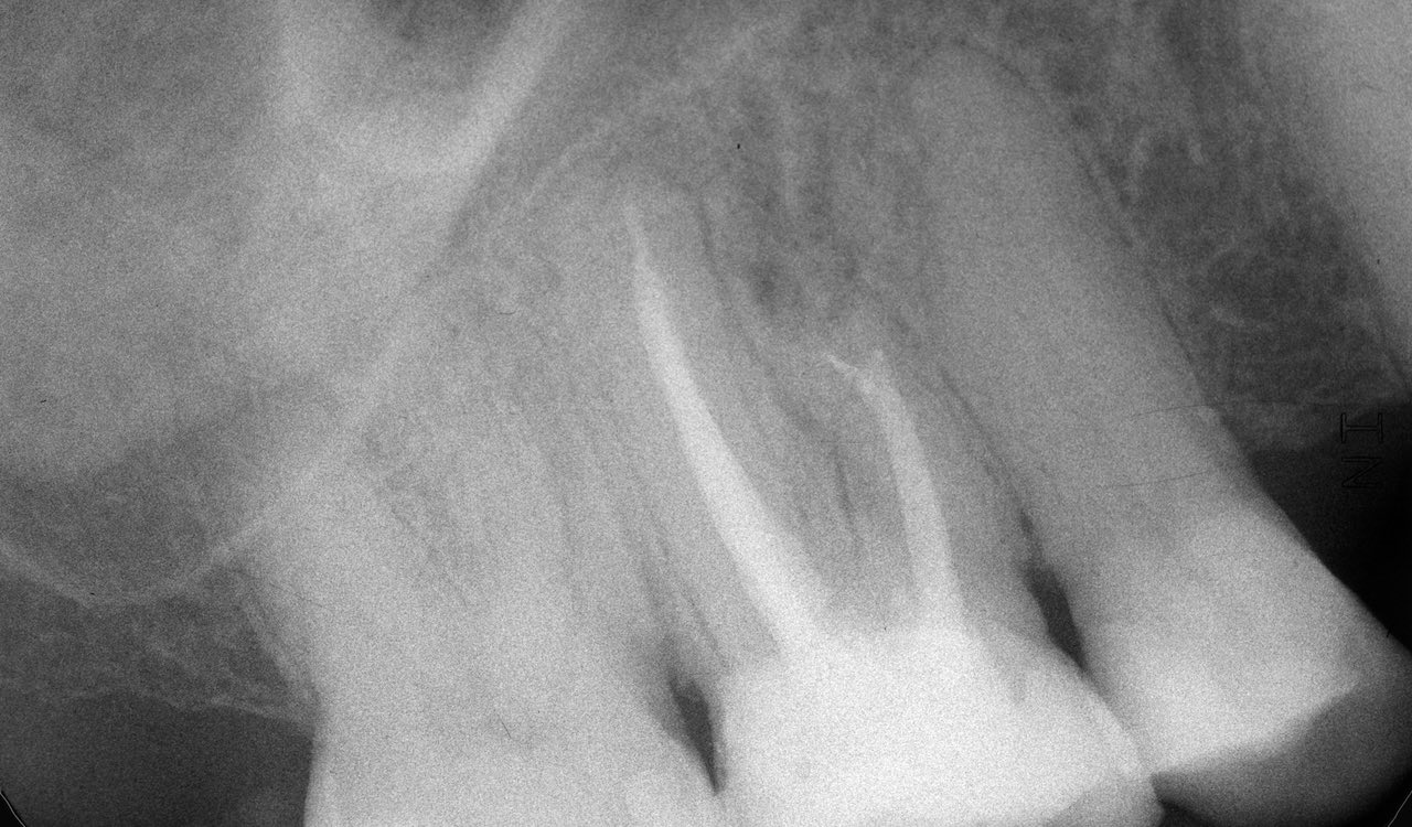 Abb. 8: Der Zahnfilm, aufgenommen sieben Monate nach Wurzelspitzenresektion und retrogradem Verschluss mit Biodentine zeigt eine vollständige knöcherne Regeneration im Bereich der mesiobukkalen Wurzel. Pathologischen Veränderungen apikal an Zahn 16 waren nicht sichtbar. (Foto: Dammaschke)