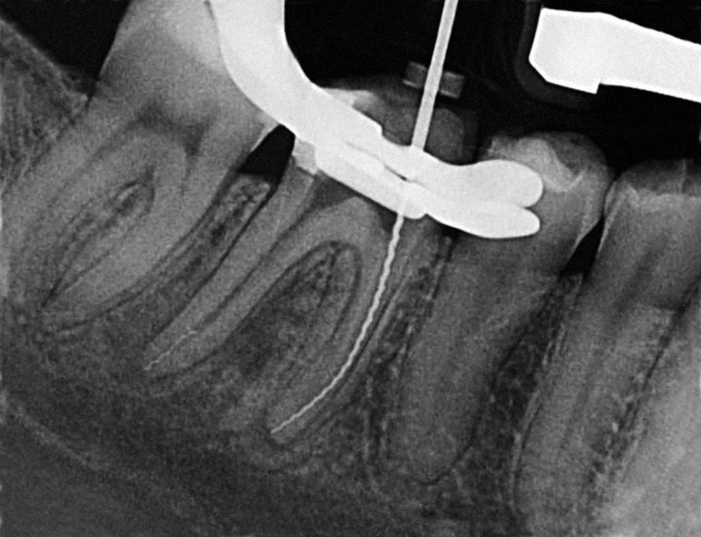 Abb. 3 Röntgenaufnahme zur Kontrolle der Fragmententfernung mit inserierter Feile im mesio-bukkalen Kanal. Im distalen Wurzelkanal ist jetzt ein Fragment zu erkennen.