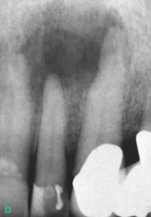 Abb. 2: In der diagnostischen Röntgenaufnahme zeigt sich apikal des Eckzahns eine vergleichsweise kleine Läsion und apikal des seitlichen Schneidezahnes eine ausgedehnte Radioluzenz, obwohl der Zahn noch positiv auf den Kältetest reagierte. Aus: Oei/Hülsmann, Der akute apikale Prozess, Endodontie 2018;27(2):143–152