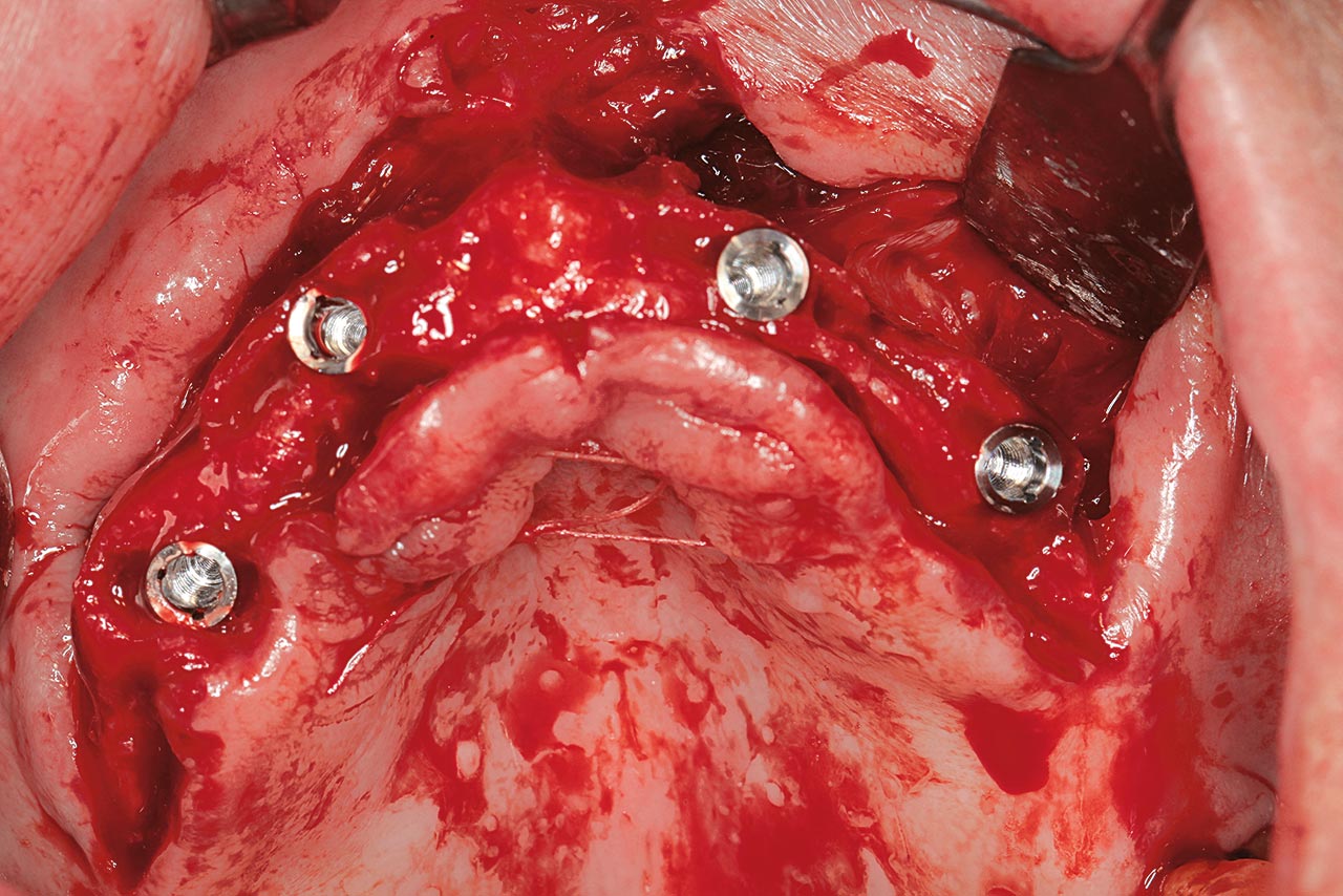Abb. 8 Zustand im Anschluss an die Implantation nach vorherigem Bone Splitting