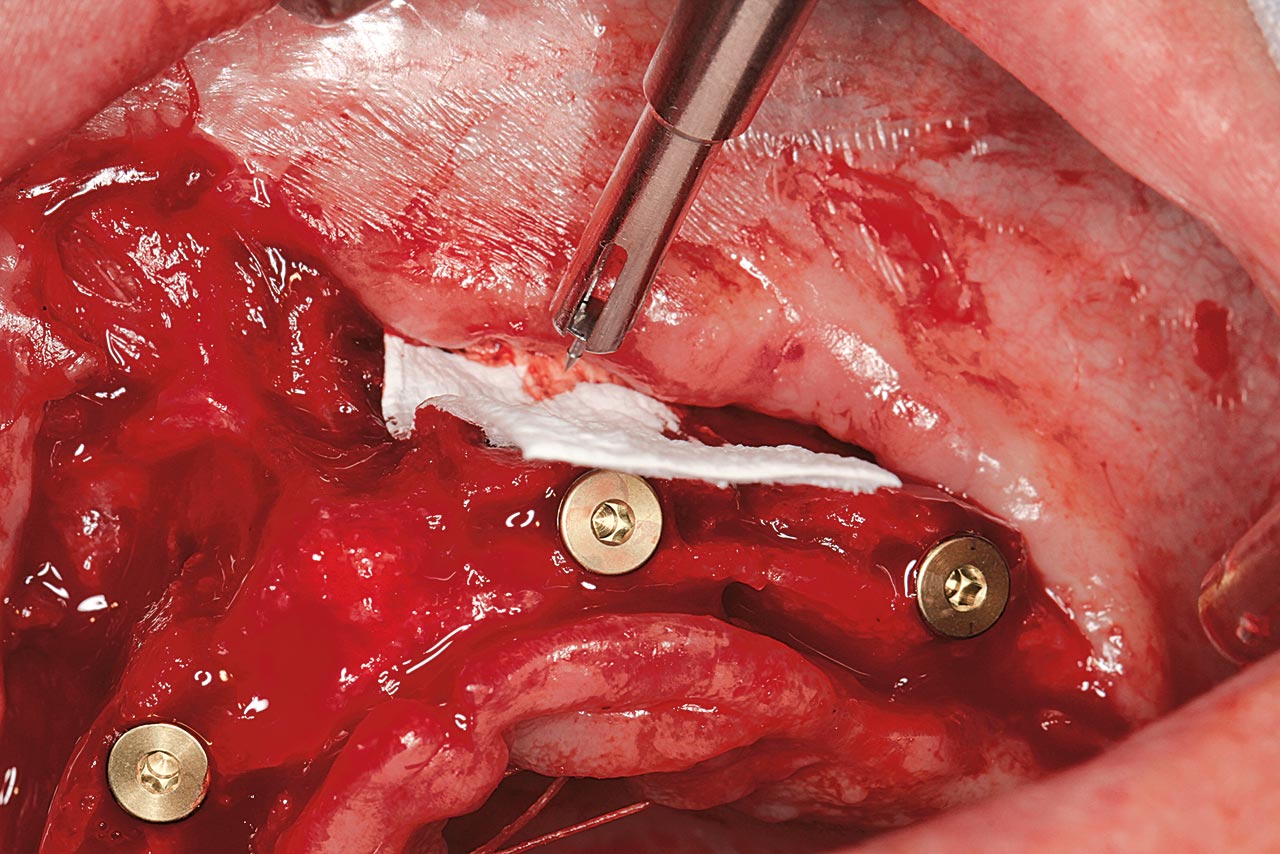 Abb. 9 Zustand nach Bone Splitting und Implantation sowie vor lateraler Augmentation der bukkalen Lamelle