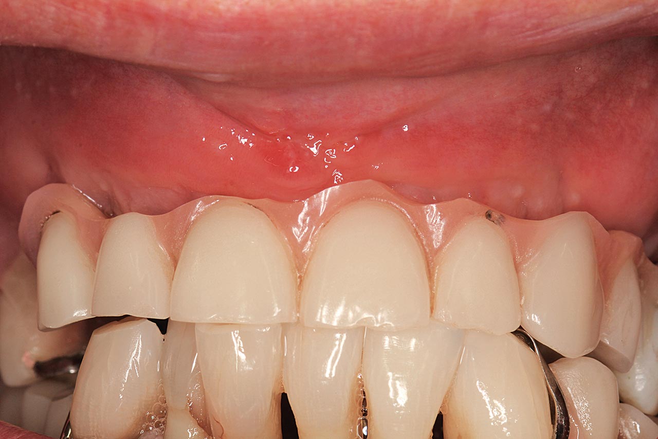 Abb. 19 Basal stark reduzierte Interimsprothese als provisorischer Zahnersatz