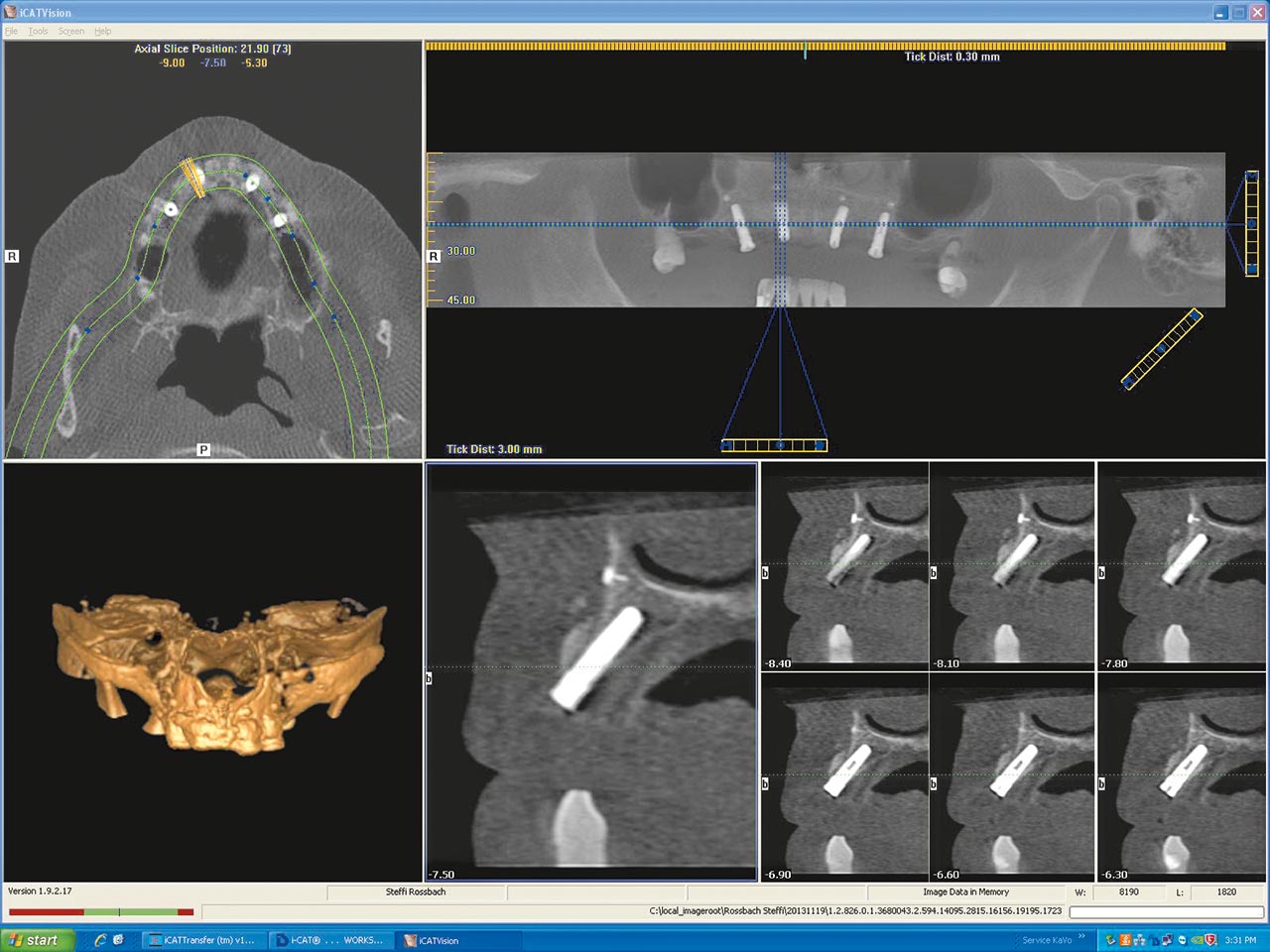 Abb. 22 DVT-Aufnahme des augmentierten Bereichs zum Zeitpunkt der Implantatfreilegung