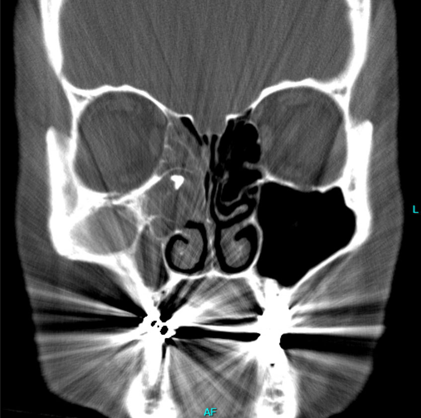 Abb. 1: Das NNH CT zeigt im koronaren Schnittbild die komplett verschattete Nasennebenhöhle rechts und das Aspergillom, zunächst Verdacht auf einen metallischen Fremdkörper (November 2011).