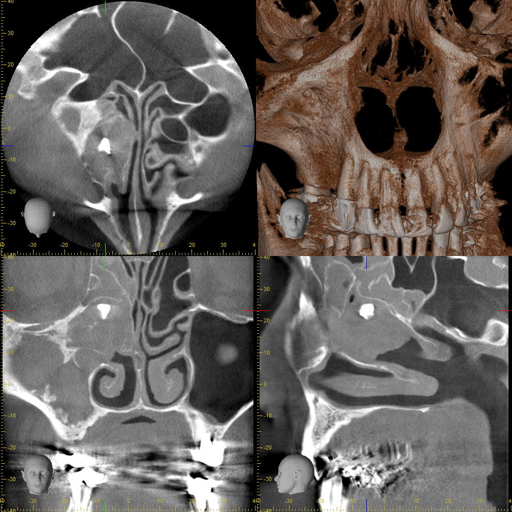 Abb. 2: Das präoperative DVT zeigt in allen drei Ebenen die vollständig verschattete Nasennebenhöhle rechts mit dem Aspergillom in kranialen Bereich. Aufgrund der chronischen Entzündung sind deutliche Umbauprozesse der knöchernen Strukturen rechts sichtbar.