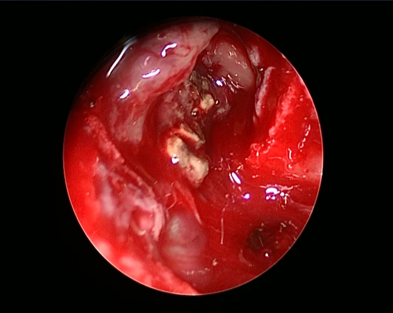 Abb. 4: Das intraoperative Bild zeigt den Blick in den Sinus maxillaris rechts, gefüllt mit grau-grünlichem Fremdmaterial und entzündlich veränderter Nasennebenhöhlenschleimhaut.