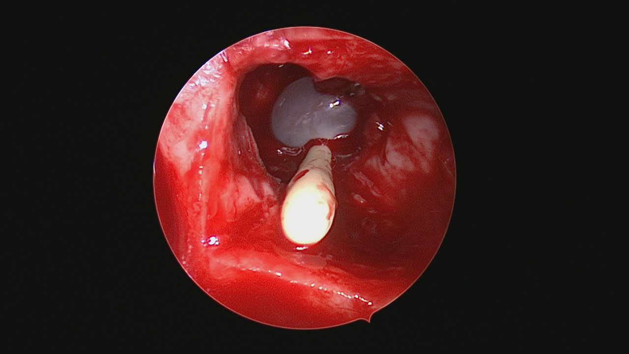 Abb. 5: Das intraoperative Bild zeigt den eingebrachten Blasenkatheter, der zur Spülung des Sinus maxillaris rechts genutzt wurde.