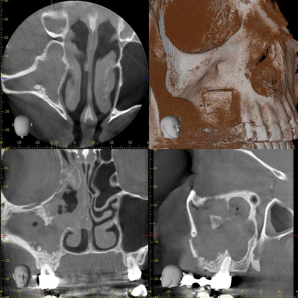 Abb. 7: Das postoperative DVT zeigt eine vollständige Entfernung des Aspergilloms und einen teilbelüfteten Sinus maxillaris rechts (September 2012).