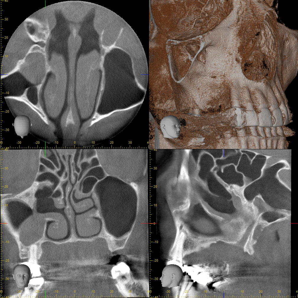 Abb. 8: Das Kontroll-DVT drei Jahre später zeigt eine Teilverschattung des Sinus maxillaris rechts. Reste des Aspergilloms sind nicht sichtbar (Februar 2015).