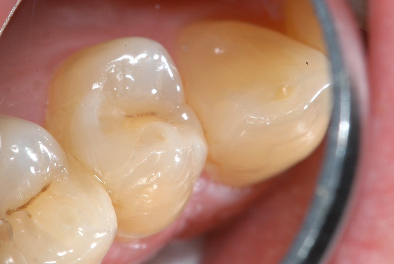 Abb. 10: Kompositfüllung an Zahn 14 sechs Monate nach dem Legen