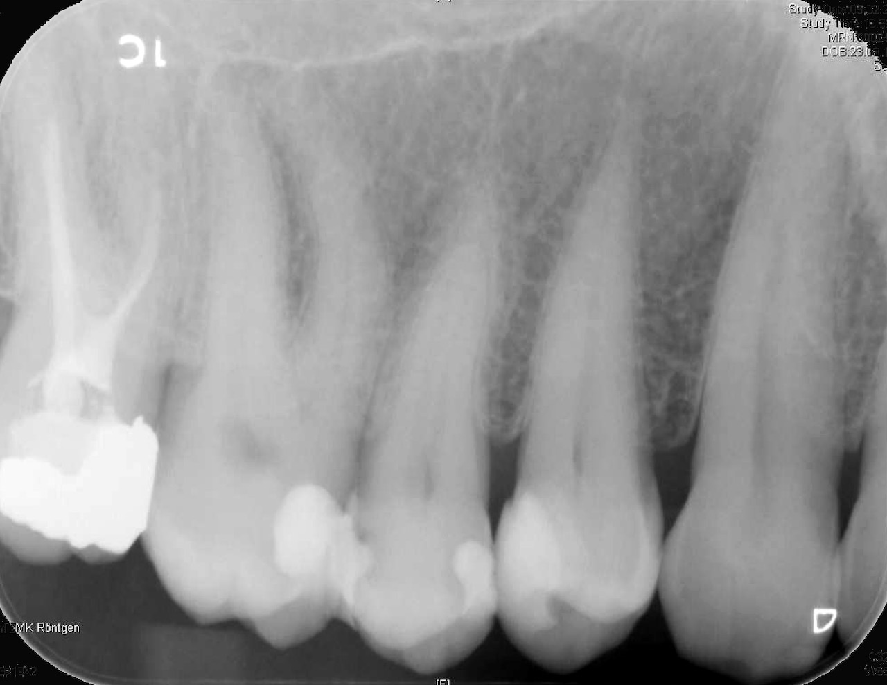 Abb. 11: Der Zahnfilm, aufgenommen 6,5 Jahre nach direkter Überkappung, zeigt keine pathologischen Veränderungen apikal an Zahn 14. Ein Nachteil von Biodentine wird auf dieser Aufnahme jedoch deutlich: die Röntgenopazität des Zements ist ähnlich der von Dentin, so dass die Schicht Biodentine unter der gut sichtbaren Kompositrestauration kaum vom Zahnhartgewebe zu unterscheiden ist.